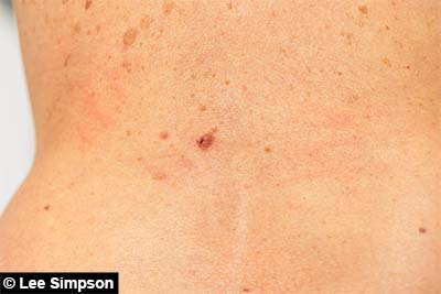 Mole on the back